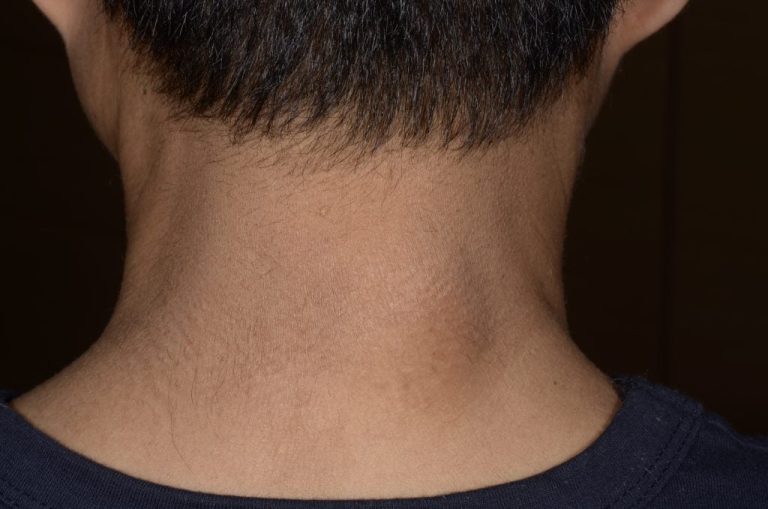 Cara Sederhana Mengenali Lipoma pada Tubuh